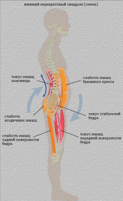 Схема боли в спине. Distal myodystrophy.