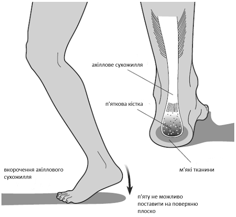 Почему перестала расти нога. Укорочение ахиллова сухожилия. Пяточное ахиллово сухожилие. Укорочение ахиловогг скожития.